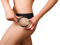 Cellulite