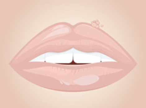 Lippenherpes