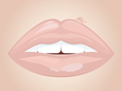 Lippenherpes