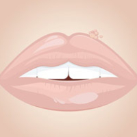 Lippenherpes